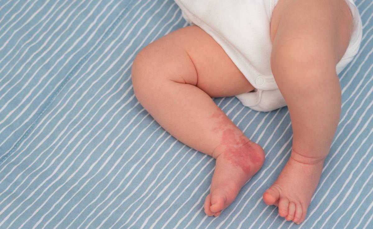 Bayi dengan tanda lahir di kaki