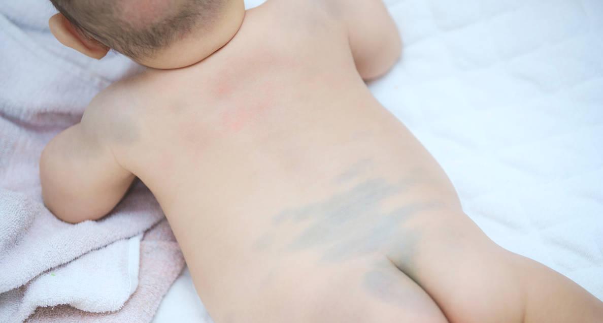 Bayi dengan mongolian spot di punggung dan bokong